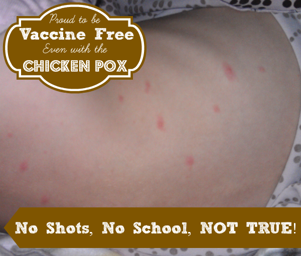 Chicken Pox 2
